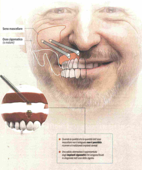 IMPIANTI ZIGOMATICI: LE IMPALCATURE CHE AIUTANO A RITROVARE IL SORRISO